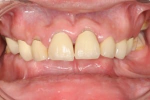 Hybrid with Orthognathic Surgery before