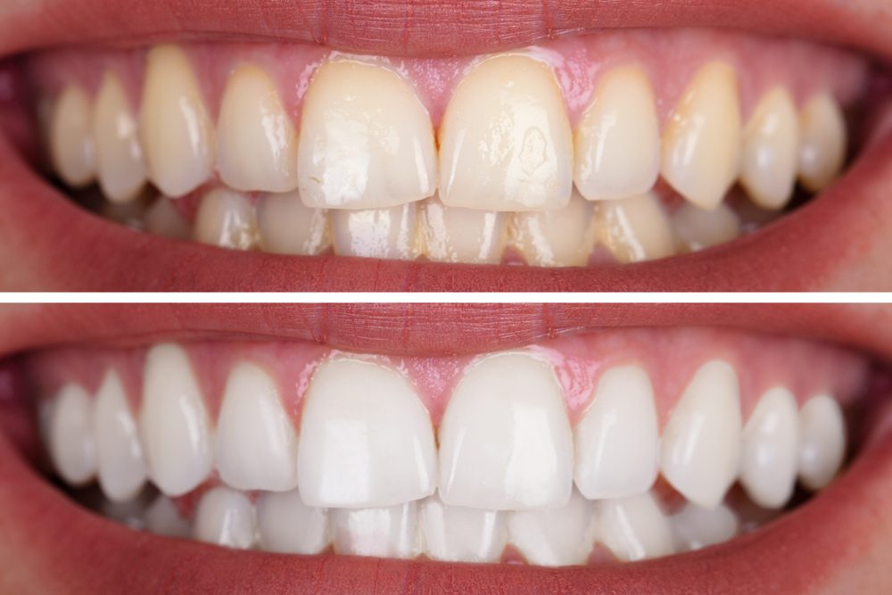 How Long Is Teeth Whitening Procedure