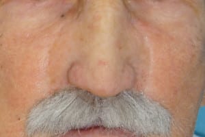 Maxillofacial Nasal Prosthesis After