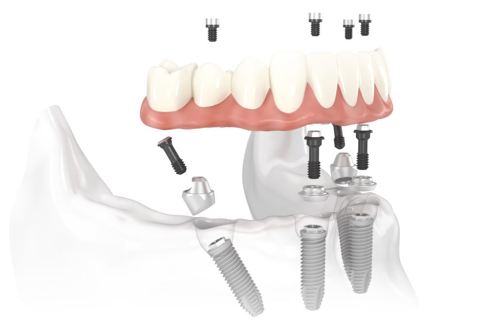 Fixed Hybrid Prosthesis Piedmont Dental Associates